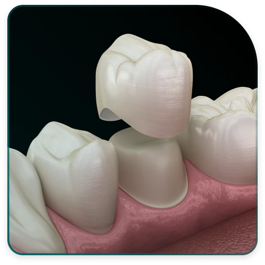 What does the process of placing dental crowns on a healthy tooth look like?
