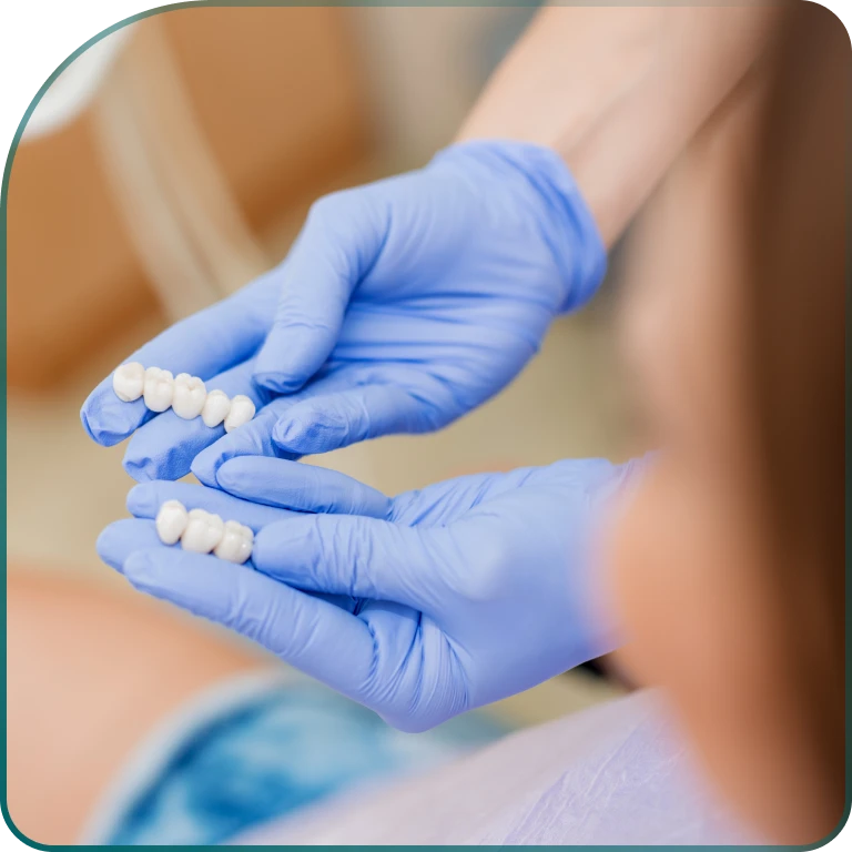 What are dental veneers?