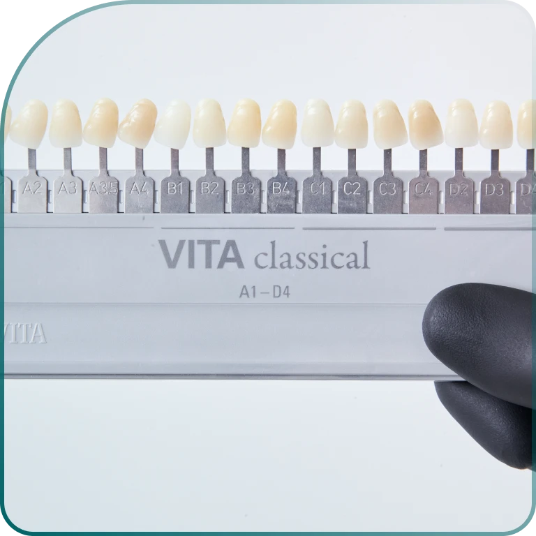 What does the making of dental veneers look like?