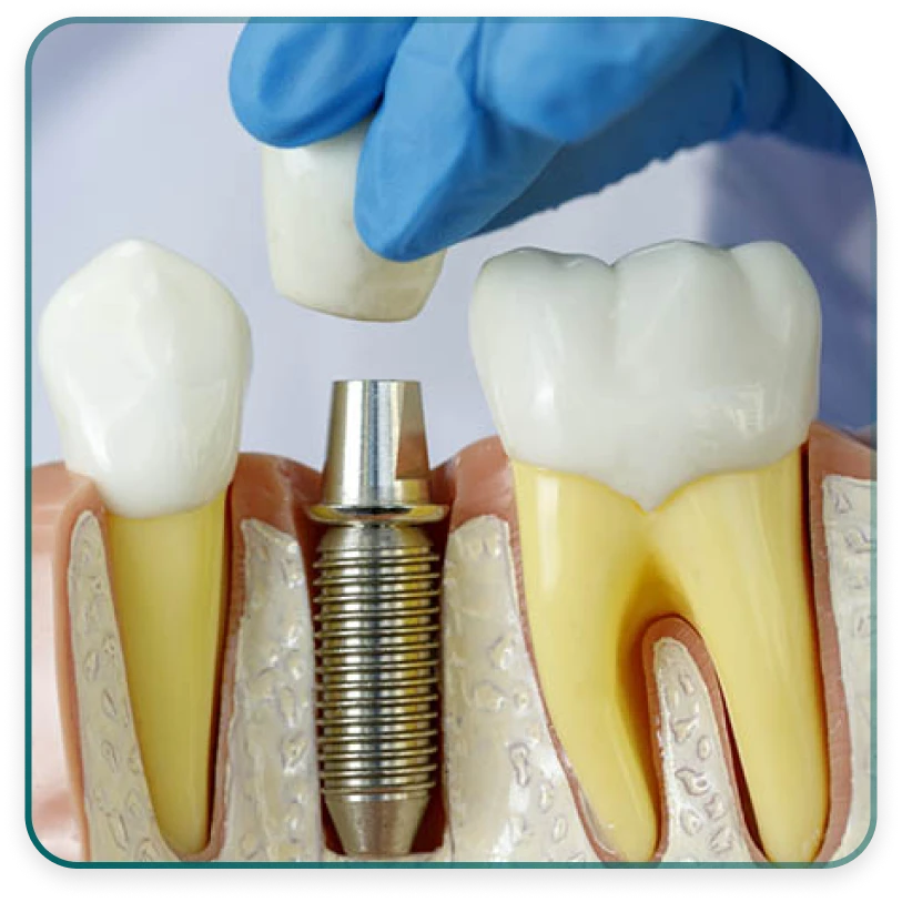 What dental implants look like