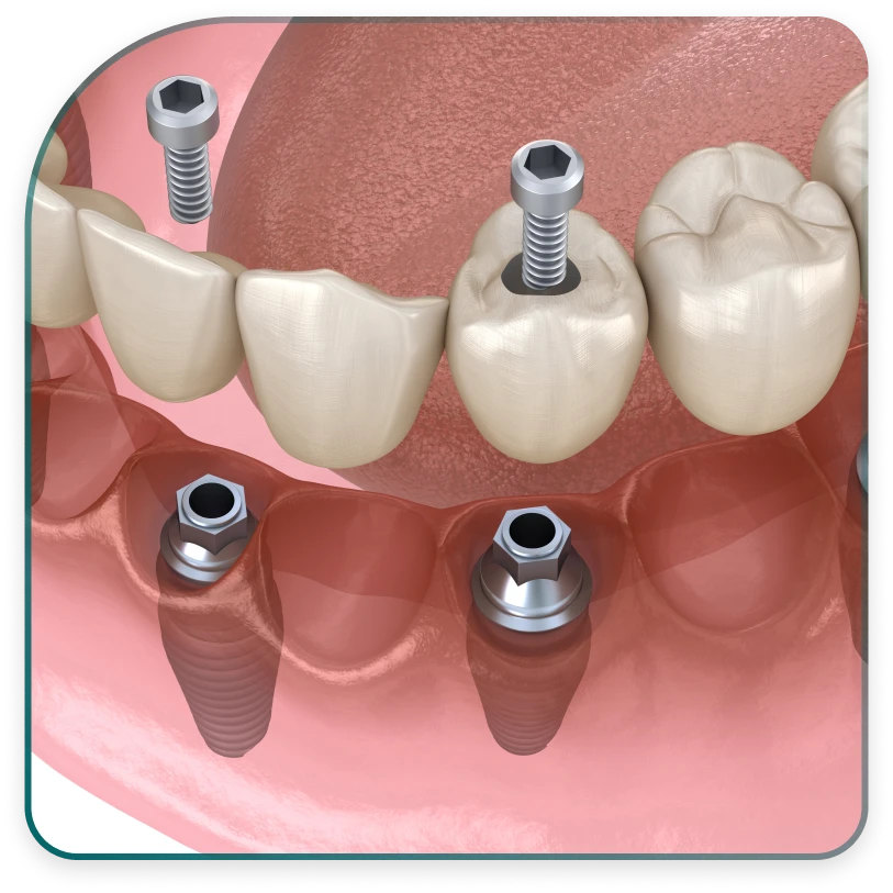 How long does dental implant installation take?