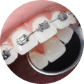 Teeth Aligners Price image