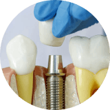 Dental Implants image