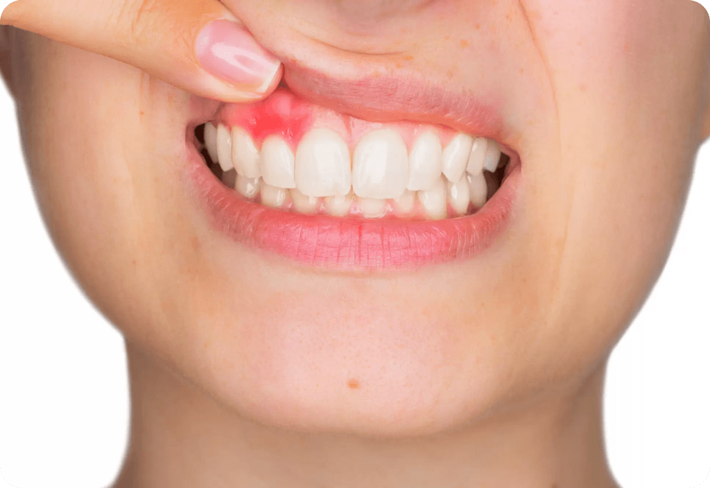 Gum Bleeding: Symptoms, Causes and Treatment