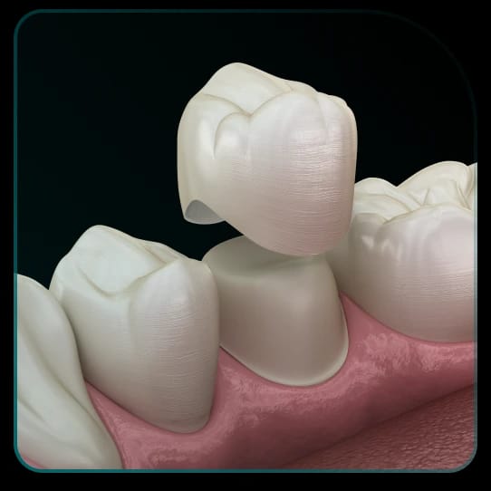 What does the process of placing dental crowns on a healthy tooth look like?