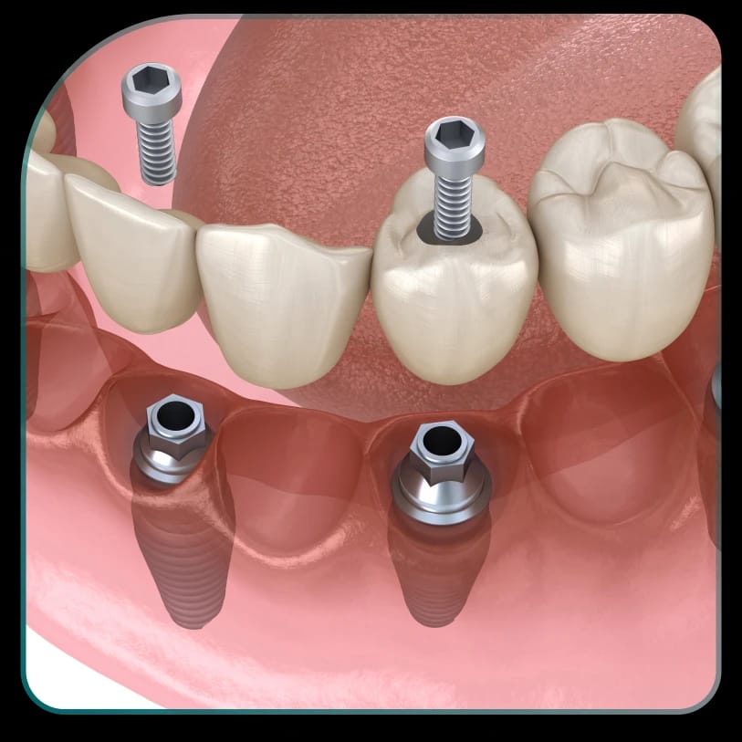 How long does dental implant installation take?