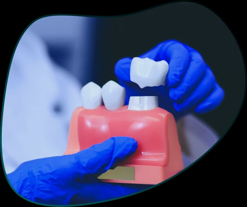Dental Crowns (Tooth Caps)