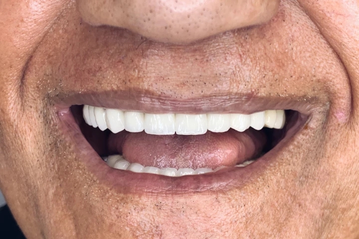 aleksandar dental tourism hollywood smile before and after