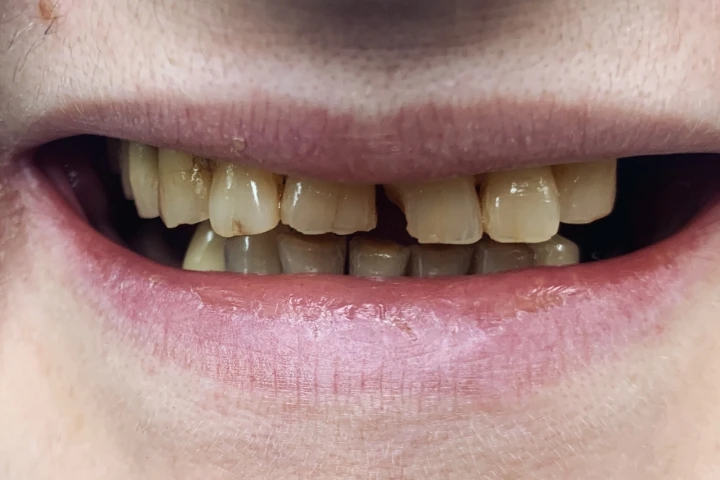 jasminka dentalni turizam hollywood smile tretman pre i posle