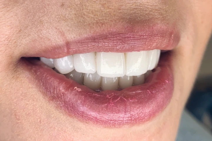 loredana hollywood smile before and after