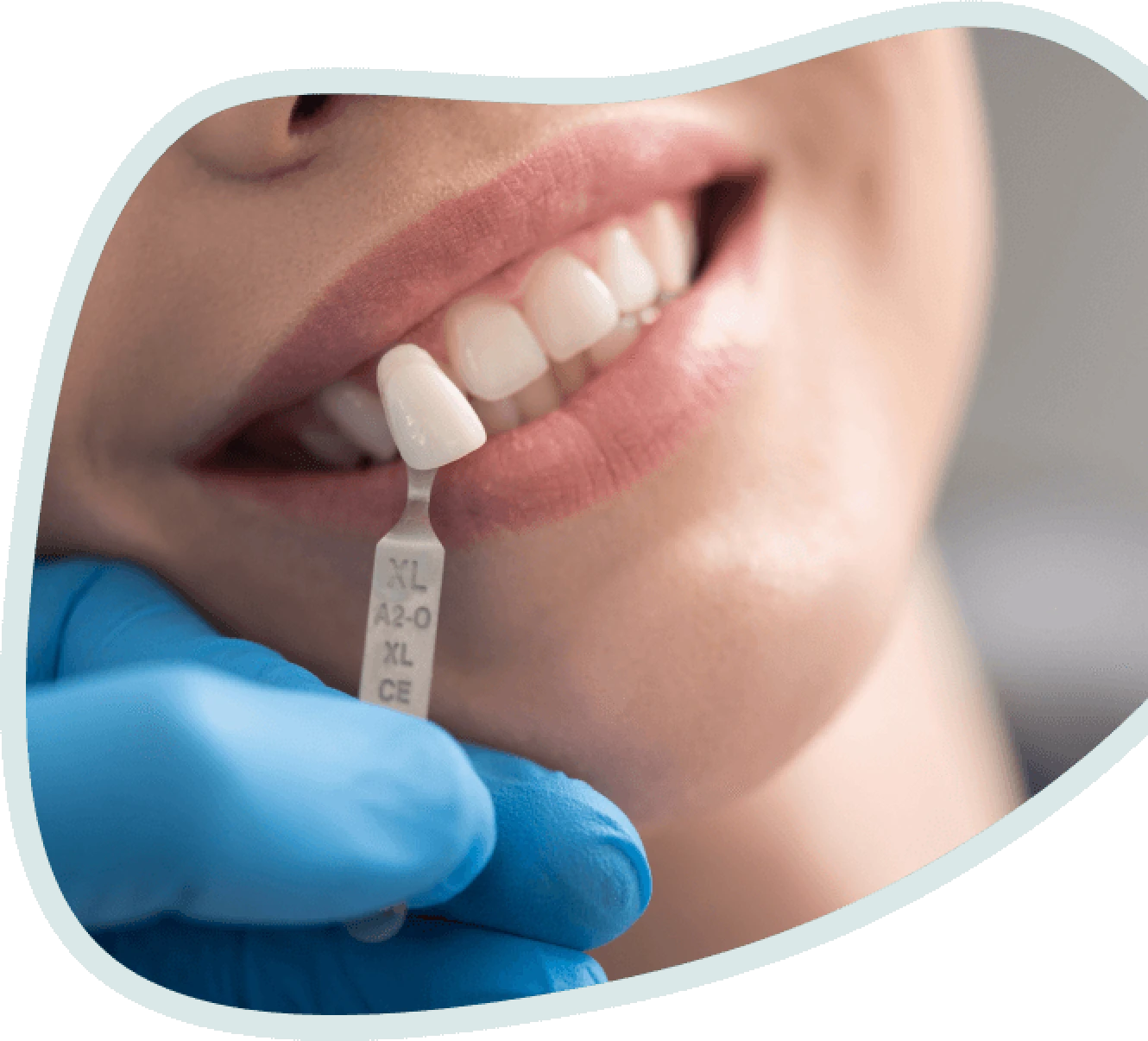Dental Veneers for teeth - veneers for teeth