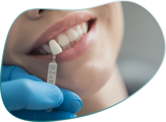 Dental Veneers for teeth - veneers for teeth