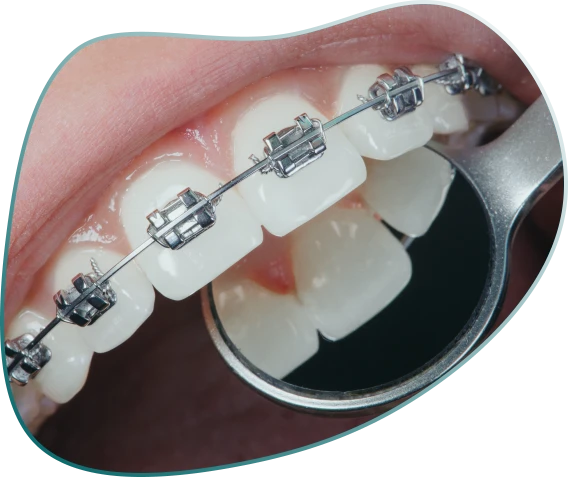 Dental Braces