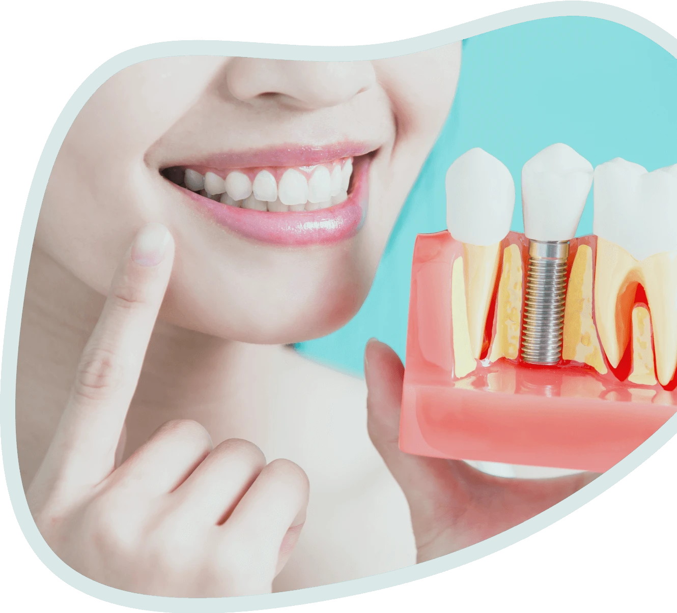 Zubni implanti - ugradnja <br className='d-none d-md-block' /> i  cene implanta zuba