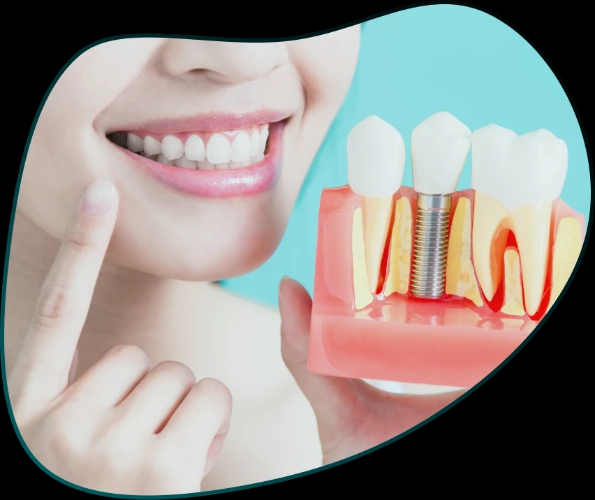 IMPLANTS - installation <br className='d-none d-md-block' /> and prices of dental implants