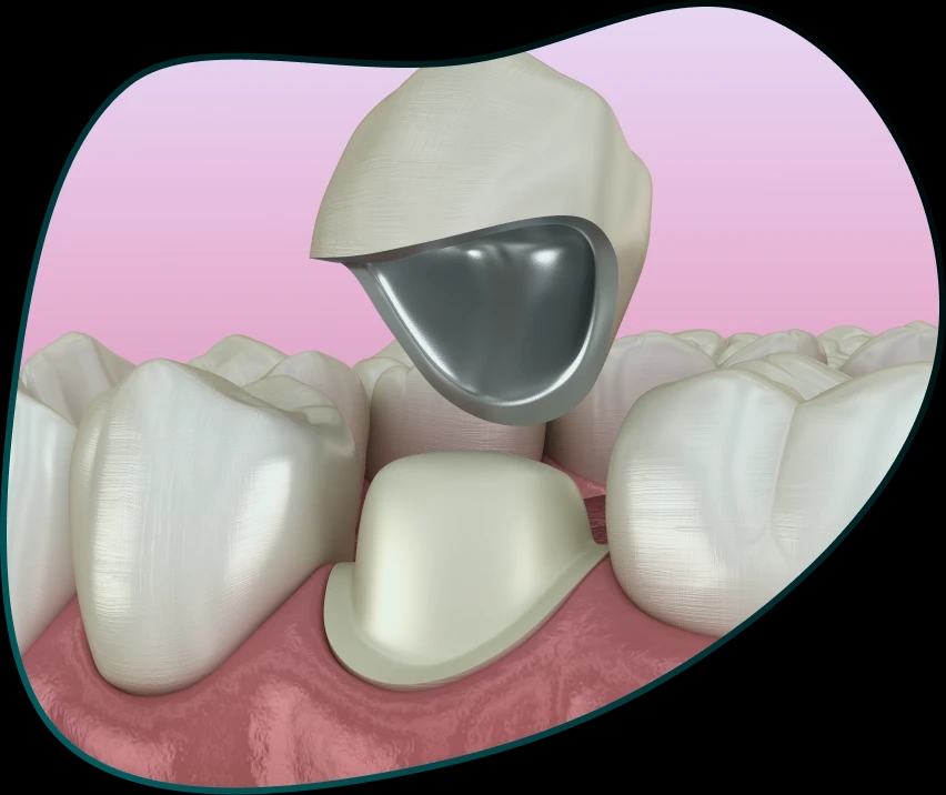 Metal-ceramic crowns