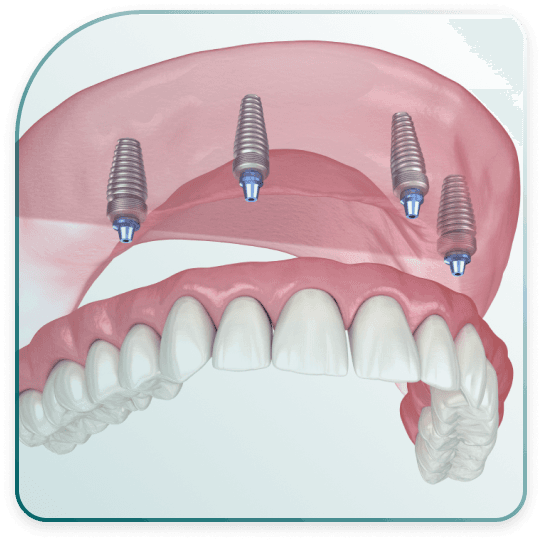 What are All on 4 implants?