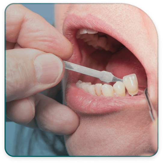 The process of installing metal-ceramic crowns