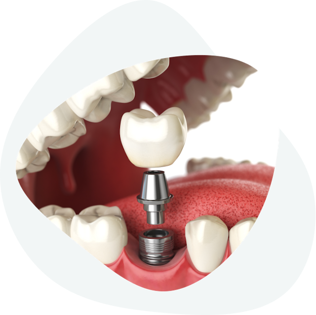 The process of placing crowns on a dental implant