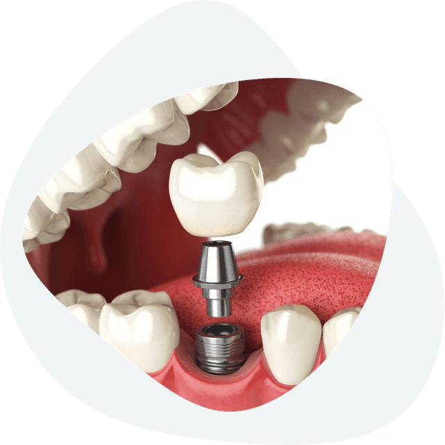 The process of placing crowns on a dental implant