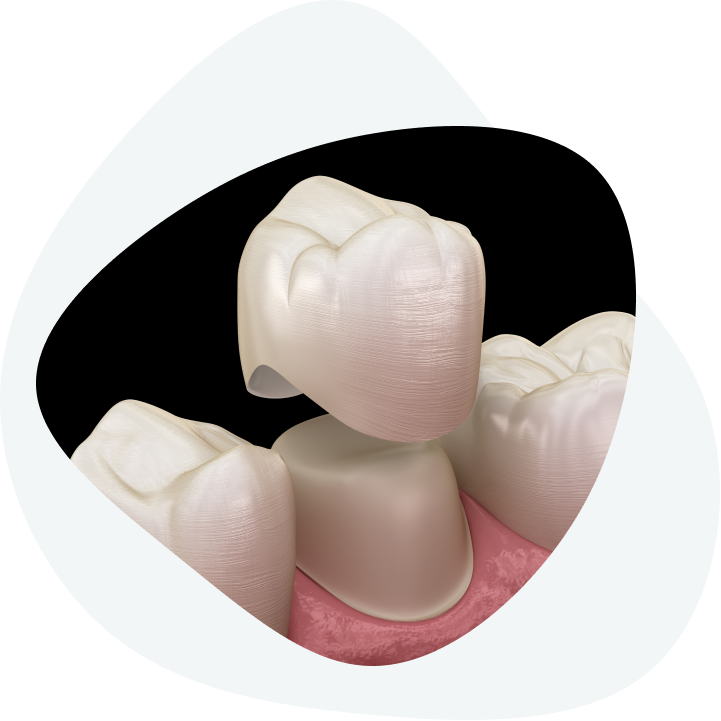 What does the process of placing dental crowns on a healthy tooth look like?