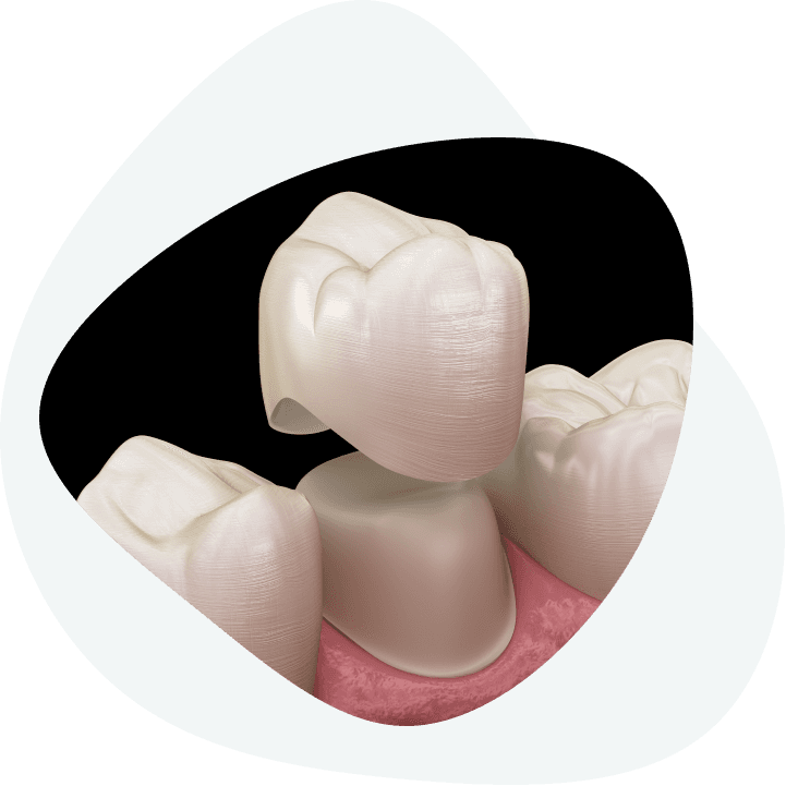 What does the process of placing dental crowns on a healthy tooth look like?