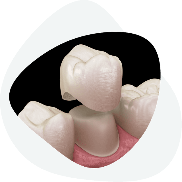 What does the process of placing dental crowns on a healthy tooth look like?