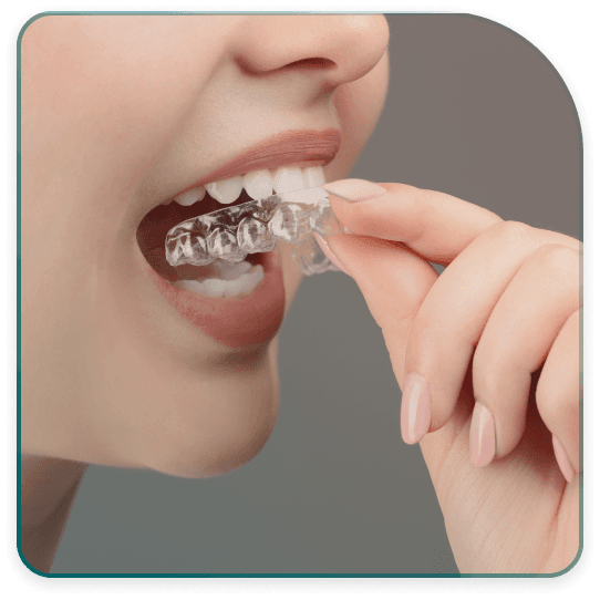 Benefits of aligners therapy?