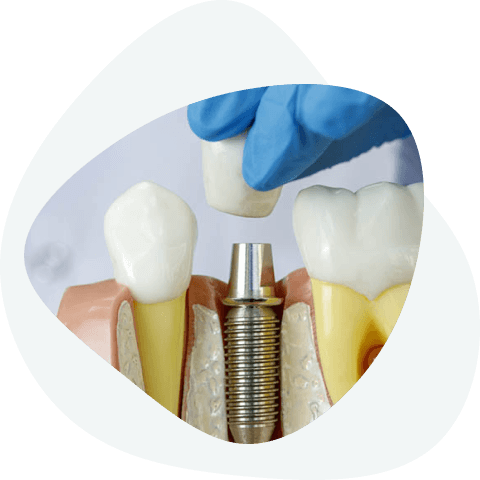 What dental implants look like