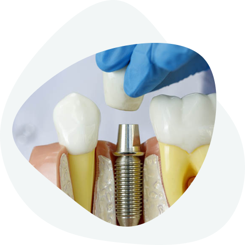 What dental implants look like