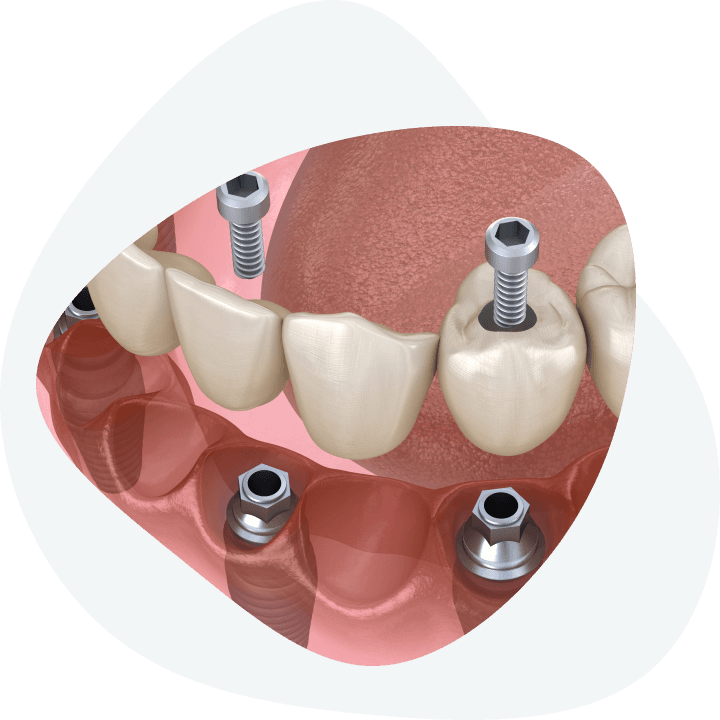 How long does dental implant installation take?