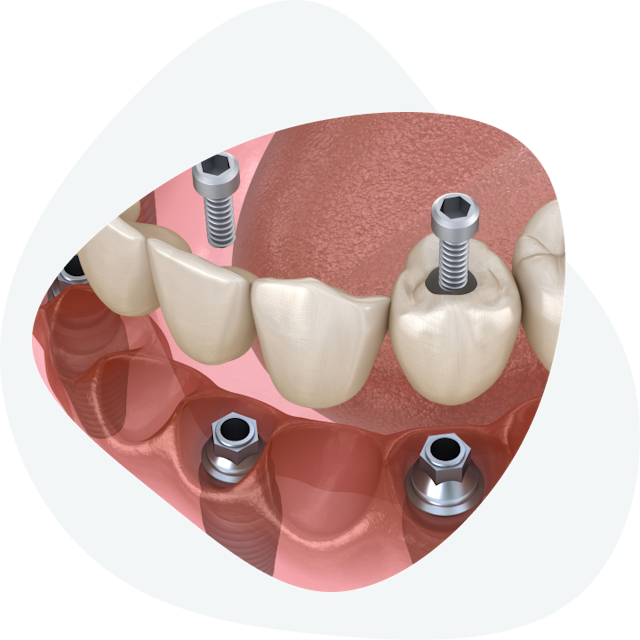 How long does dental implant installation take?
