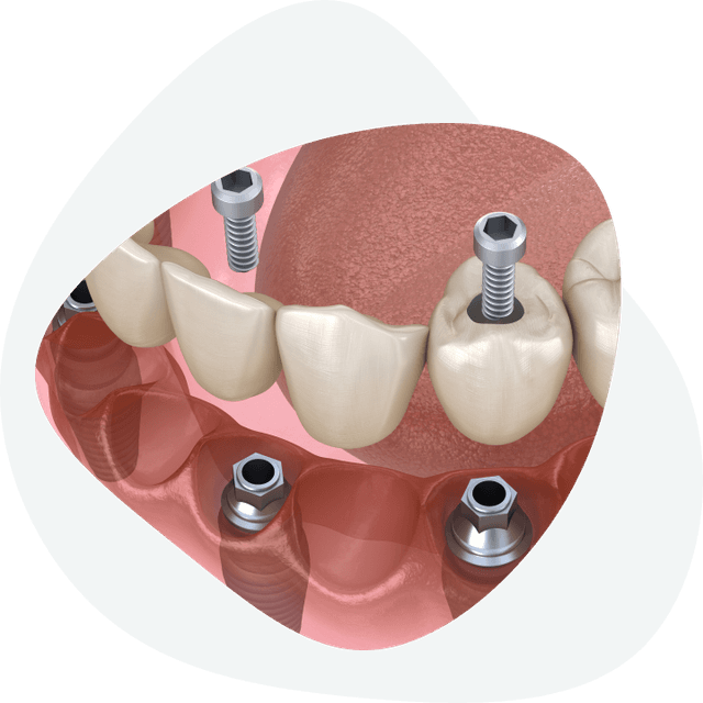 How long does dental implant installation take?