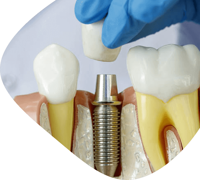 Dentalni Implanti image