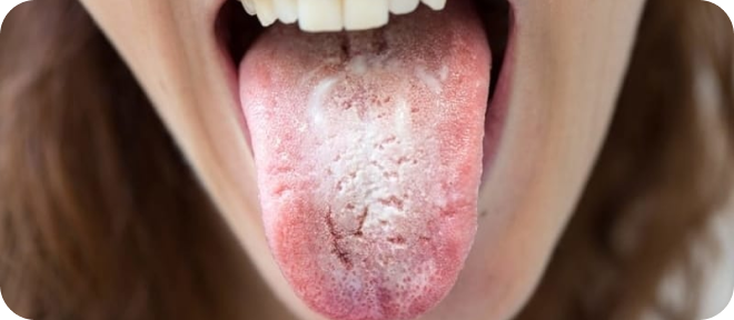 Oral Candida (Thrush): Symptoms, Treatments, Definition