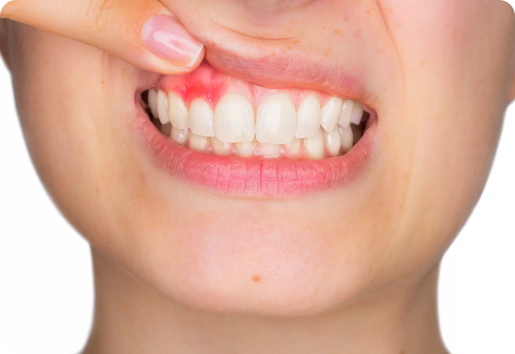 Gum Bleeding: Symptoms, Causes and Treatment