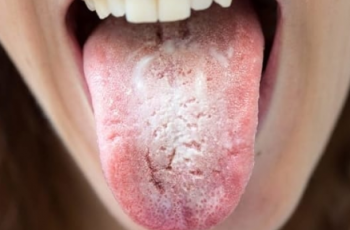 Oral Candida (Thrush): Symptoms, Treatments, Definition marco dental tourism