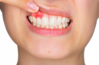 Krvarenje desni - uzroci, simptomi i lečenje marco dental tourism