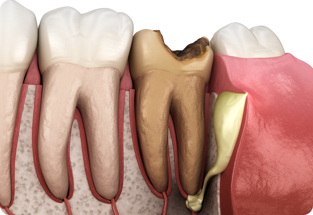 Gangrena Zuba: Simptomi i Lecenje