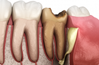 Pulp Necrosis or Dental Gangrene: Causes, Treatment marco dental tourism
