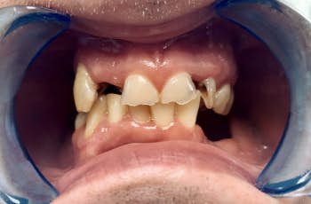 Sve Sto Treba da Znate o Eroziji Zuba marco dental tourism