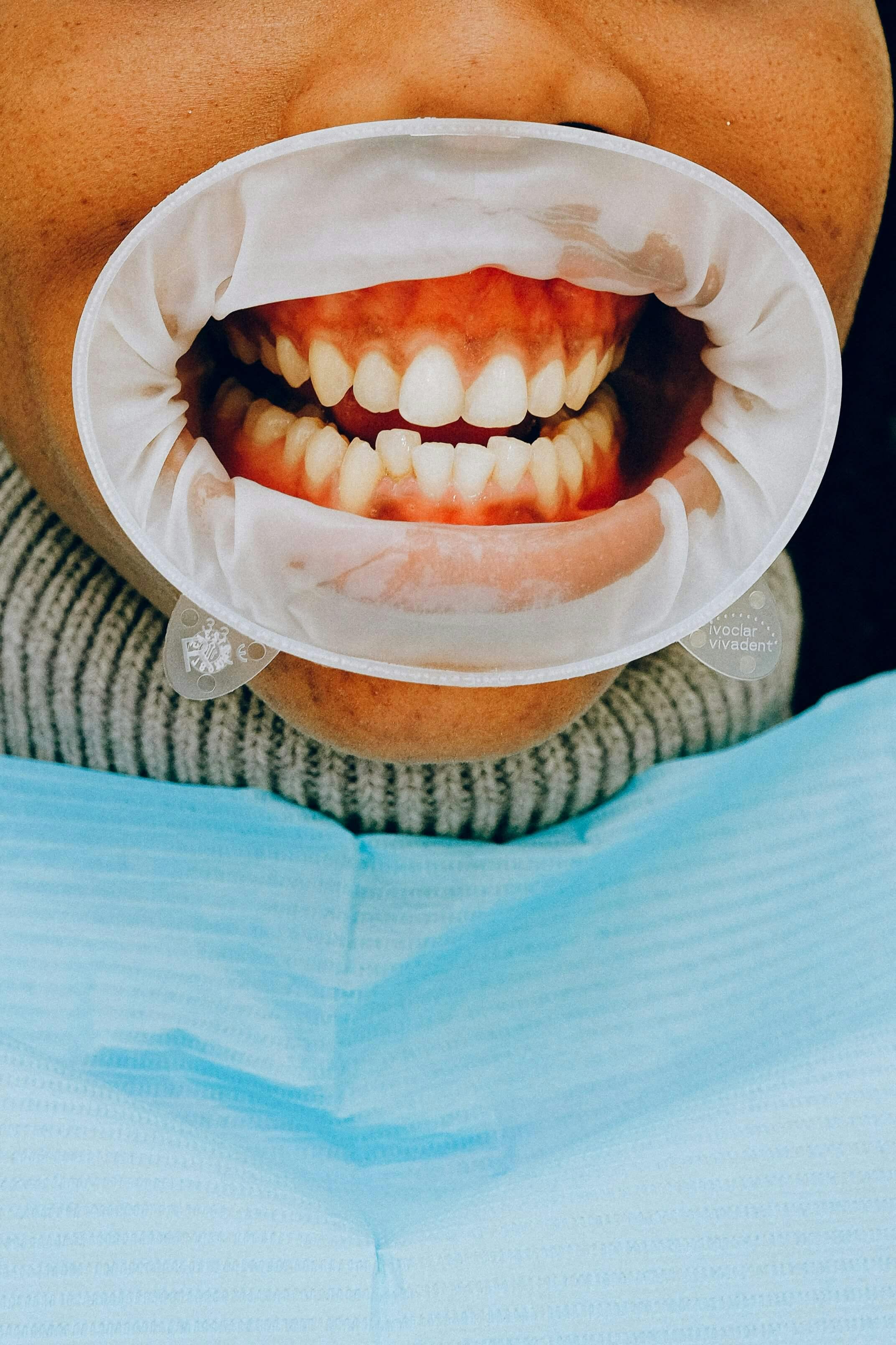 Krivi Zubi i Kako Ih Ispraviti bez Proteze?