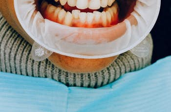 Krivi Zubi i Kako Ih Ispraviti bez Proteze? marco dental tourism
