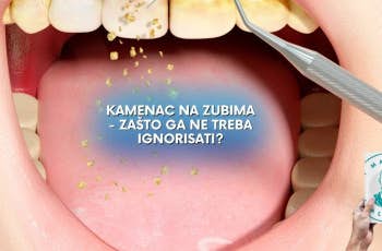 Kamenac na Zubima - Zasto ga ne Treba Ignorisati? marco dental tourism