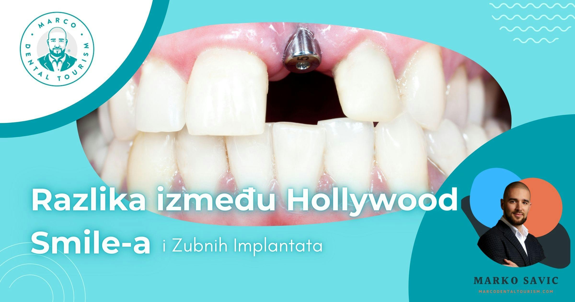 Razlika između Hollywood Smile-a i zubnih implantata - Marco Dental Tourism