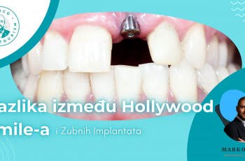 Razlika između Hollywood Smile-a i zubnih implantata - Marco Dental Tourism marco dental tourism