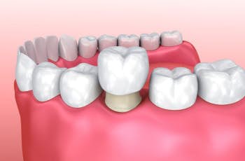 Odrzavanje Krunica za zube 5 koraka do dugotrajne izdrzljivosti marco dental tourism