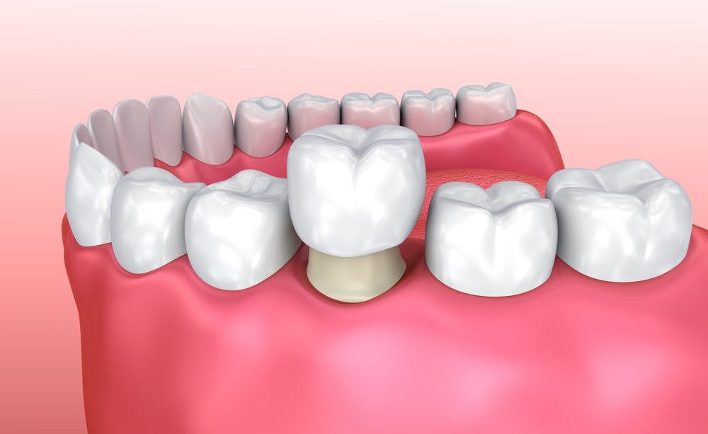 Odrzavanje Krunica za zube 5 koraka do dugotrajne izdrzljivosti
