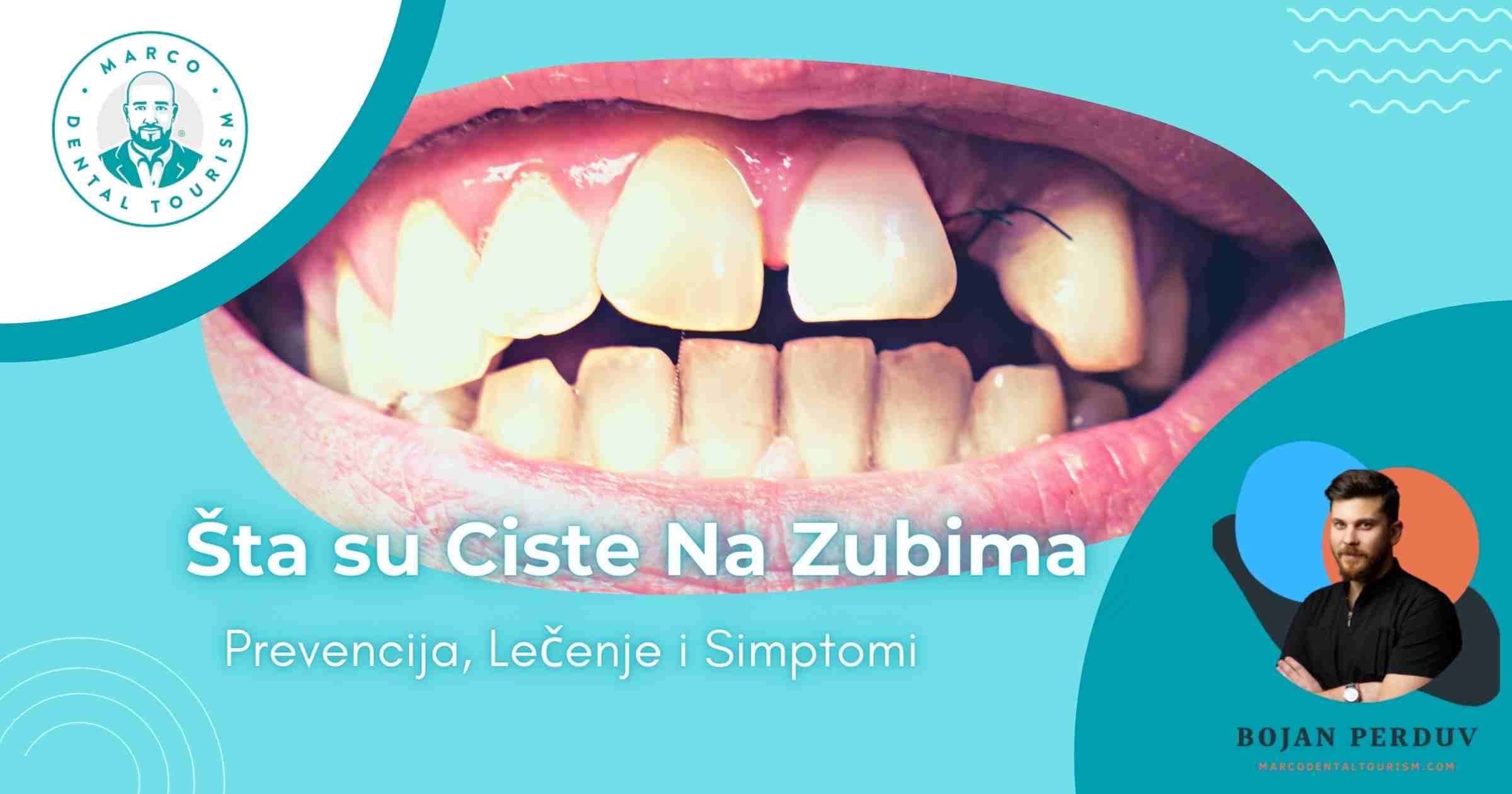 Ciste na Zubima