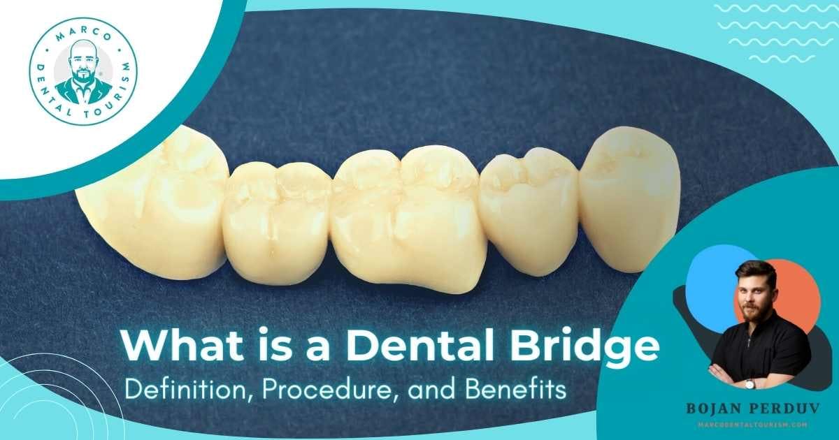 What is a Dental Bridge: Definition, Procedure, and Benefits